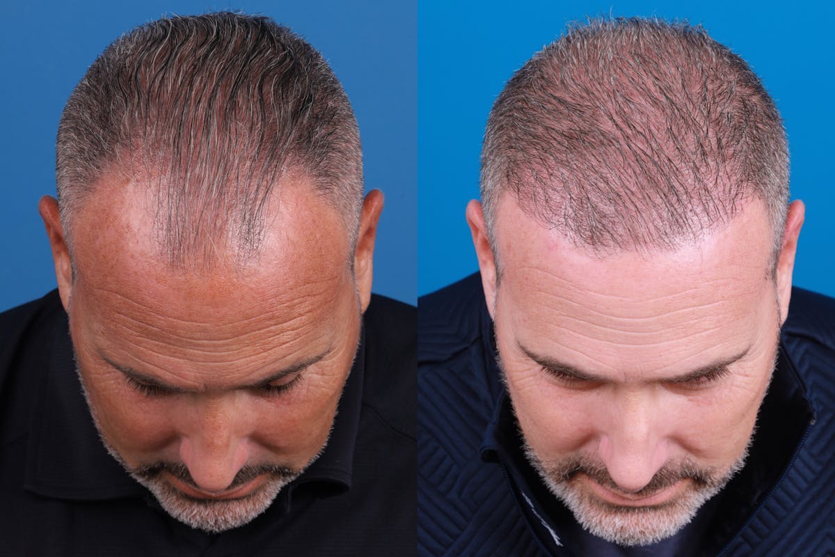 Hair Restoration Before & After Gallery - Patient 257756 - Image 1