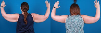 Arm Lift Before & After Gallery - Patient 226444 - Image 1