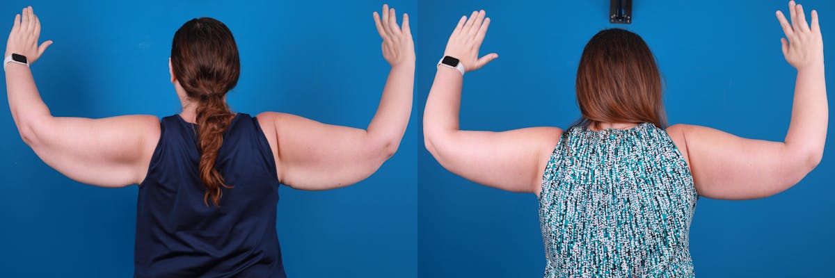 Arm Lift Before & After Gallery - Patient 226444 - Image 1