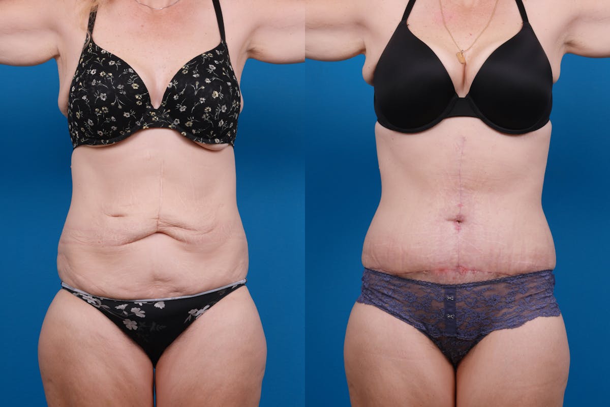 Tummy Tuck Before & After Gallery - Patient 418905 - Image 1