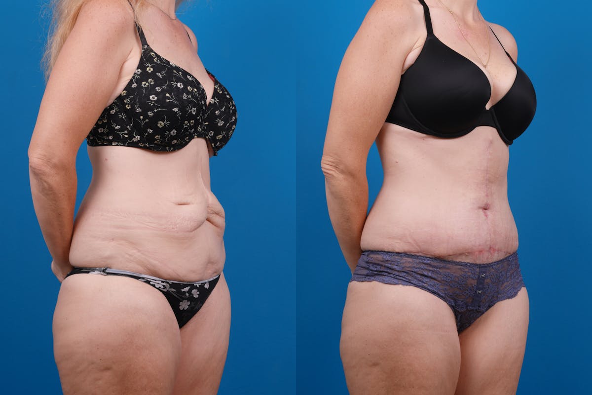 Tummy Tuck Before & After Gallery - Patient 418905 - Image 2