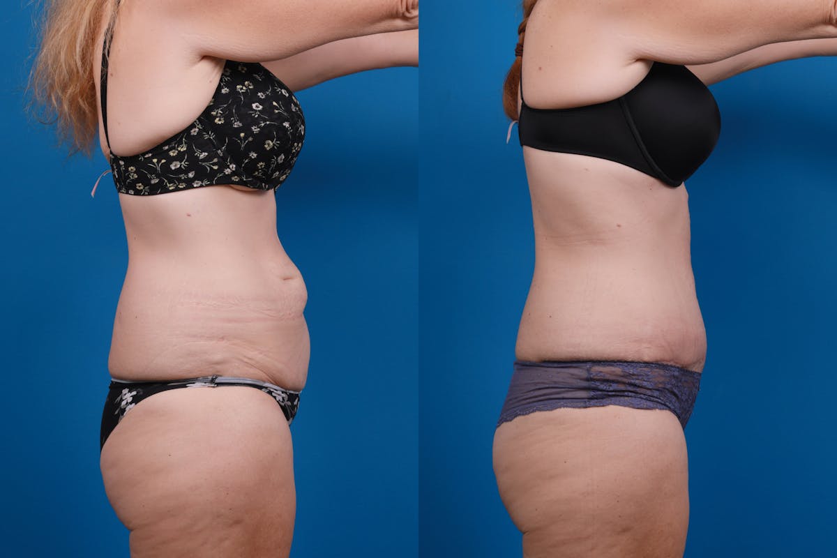 Tummy Tuck Before & After Gallery - Patient 418905 - Image 3