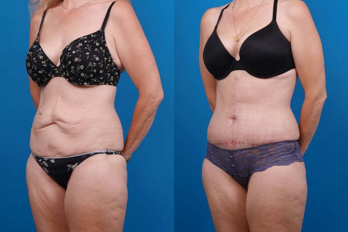 Tummy Tuck Before & After Gallery - Patient 418905 - Image 4