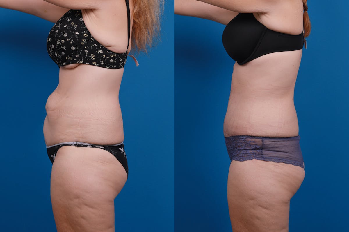 Tummy Tuck Before & After Gallery - Patient 418905 - Image 5