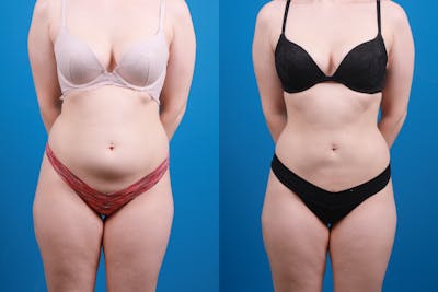 Liponique Body Contouring Before & After Gallery - Patient 220825 - Image 1