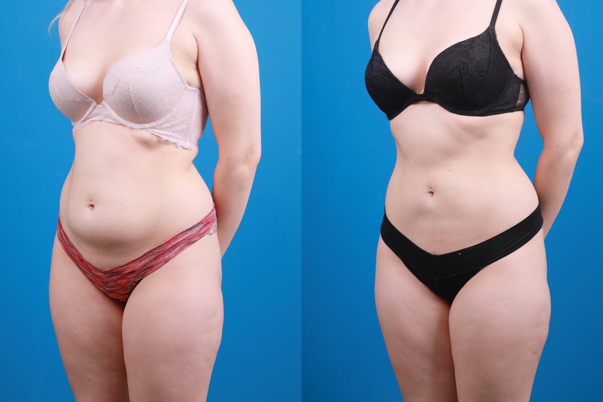 Liposuction Before & After Gallery - Patient 142283 - Image 2