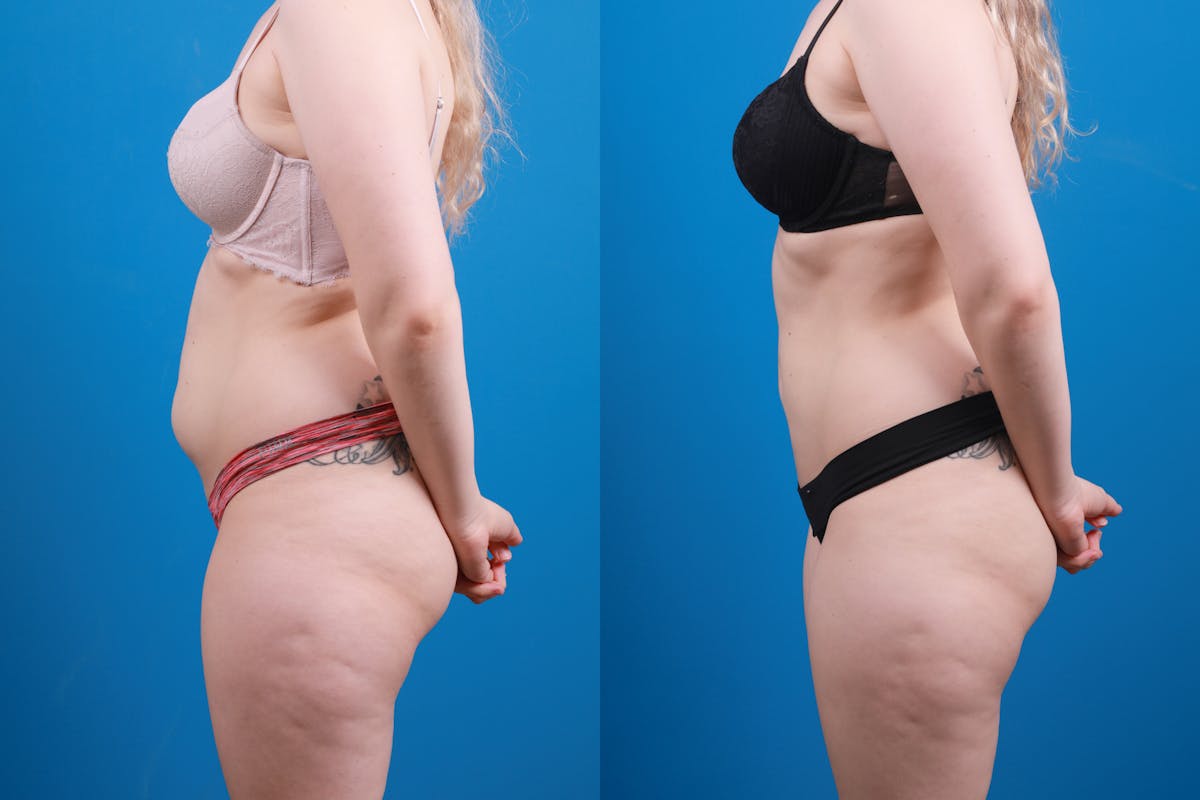 Liposuction Before & After Gallery - Patient 142283 - Image 3