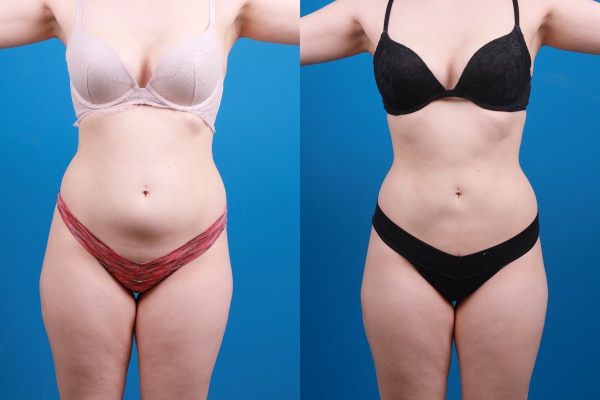Liposuction Before & After Gallery - Patient 142283 - Image 4
