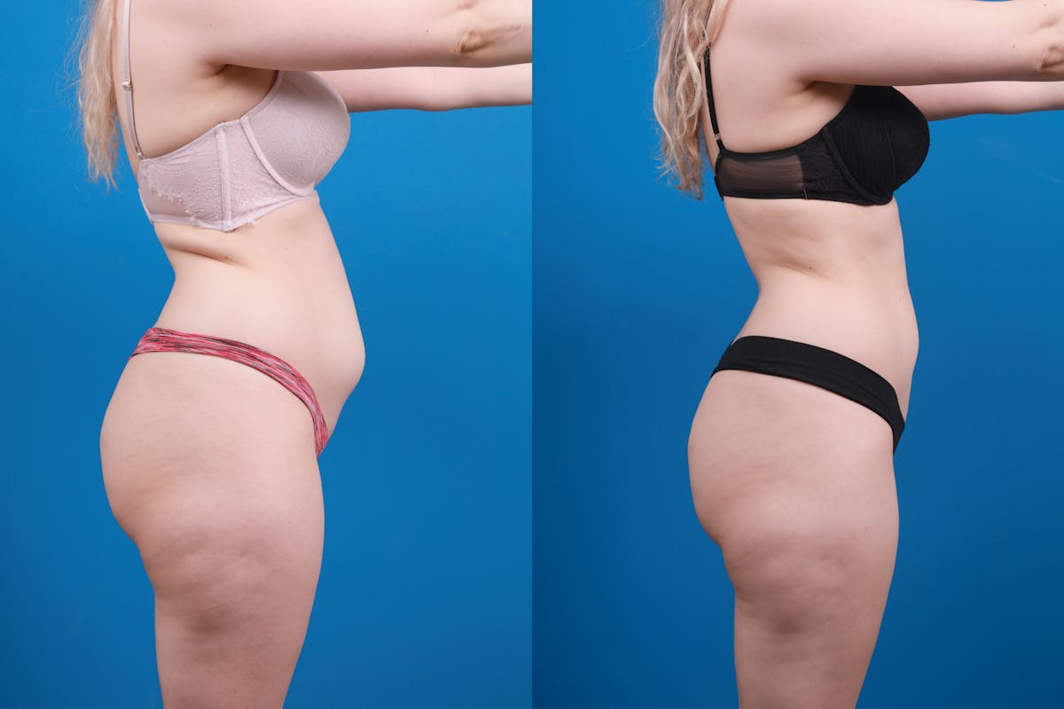 Liposuction Before & After Gallery - Patient 142283 - Image 5
