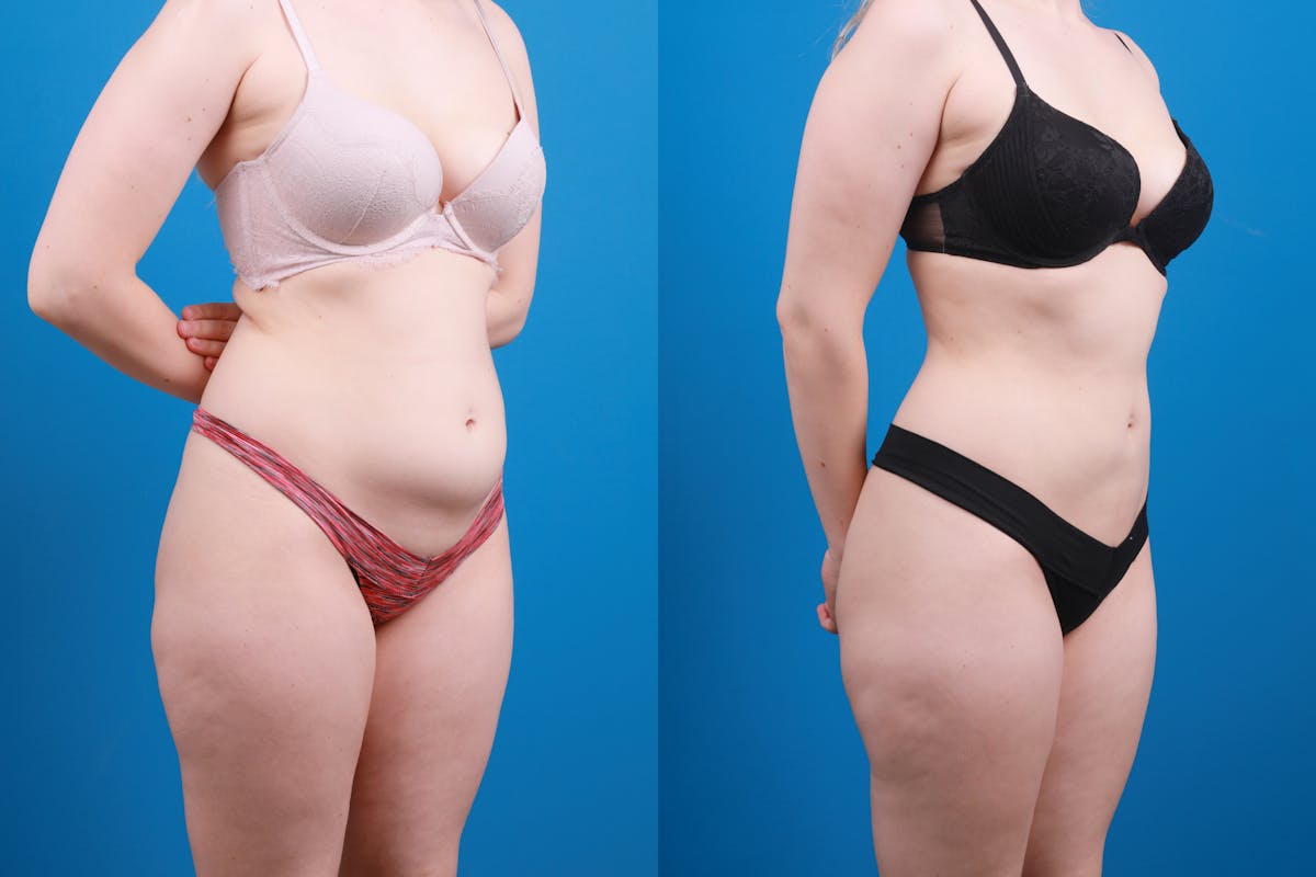 Liposuction Before & After Gallery - Patient 142283 - Image 6