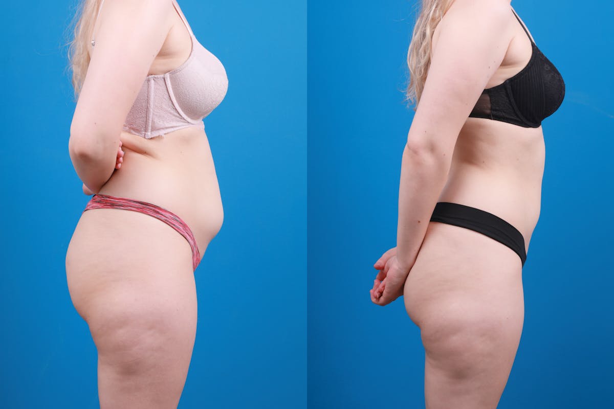 Liposuction Before & After Gallery - Patient 142283 - Image 7