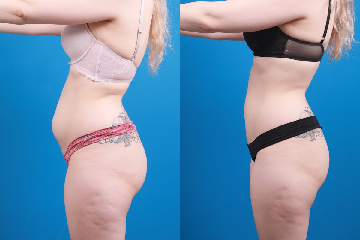 Liposuction Before & After Gallery - Patient 142283 - Image 8
