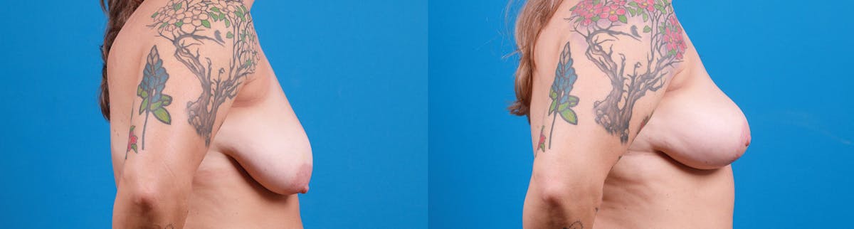 Breast Lift Before & After Gallery - Patient 124962 - Image 2