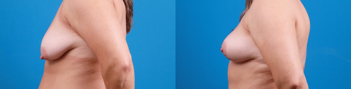 Breast Lift Before & After Gallery - Patient 124962 - Image 3
