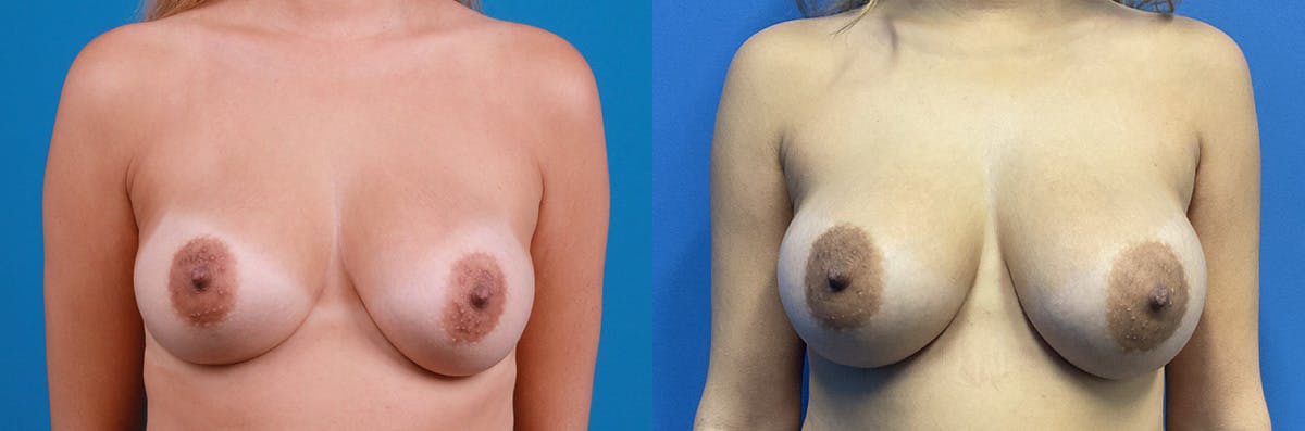 Breast Augmentation Before & After Gallery - Patient 423429 - Image 1