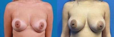 Breast Augmentation Before & After Gallery - Patient 423429 - Image 1