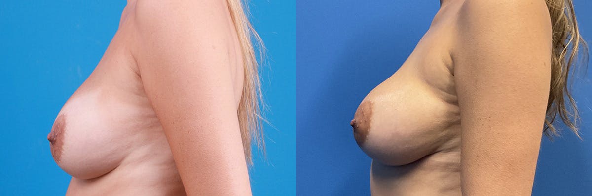 Breast Augmentation Before & After Gallery - Patient 423429 - Image 2