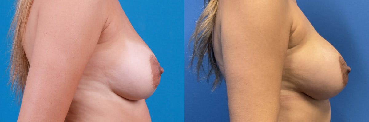 Breast Augmentation Before & After Gallery - Patient 423429 - Image 3