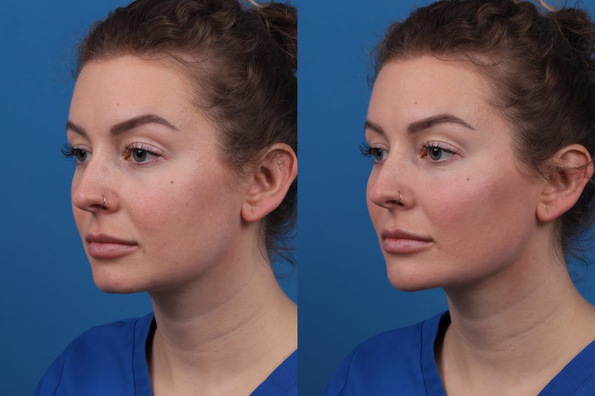 Dermal Fillers Before & After Gallery - Patient 327316 - Image 3