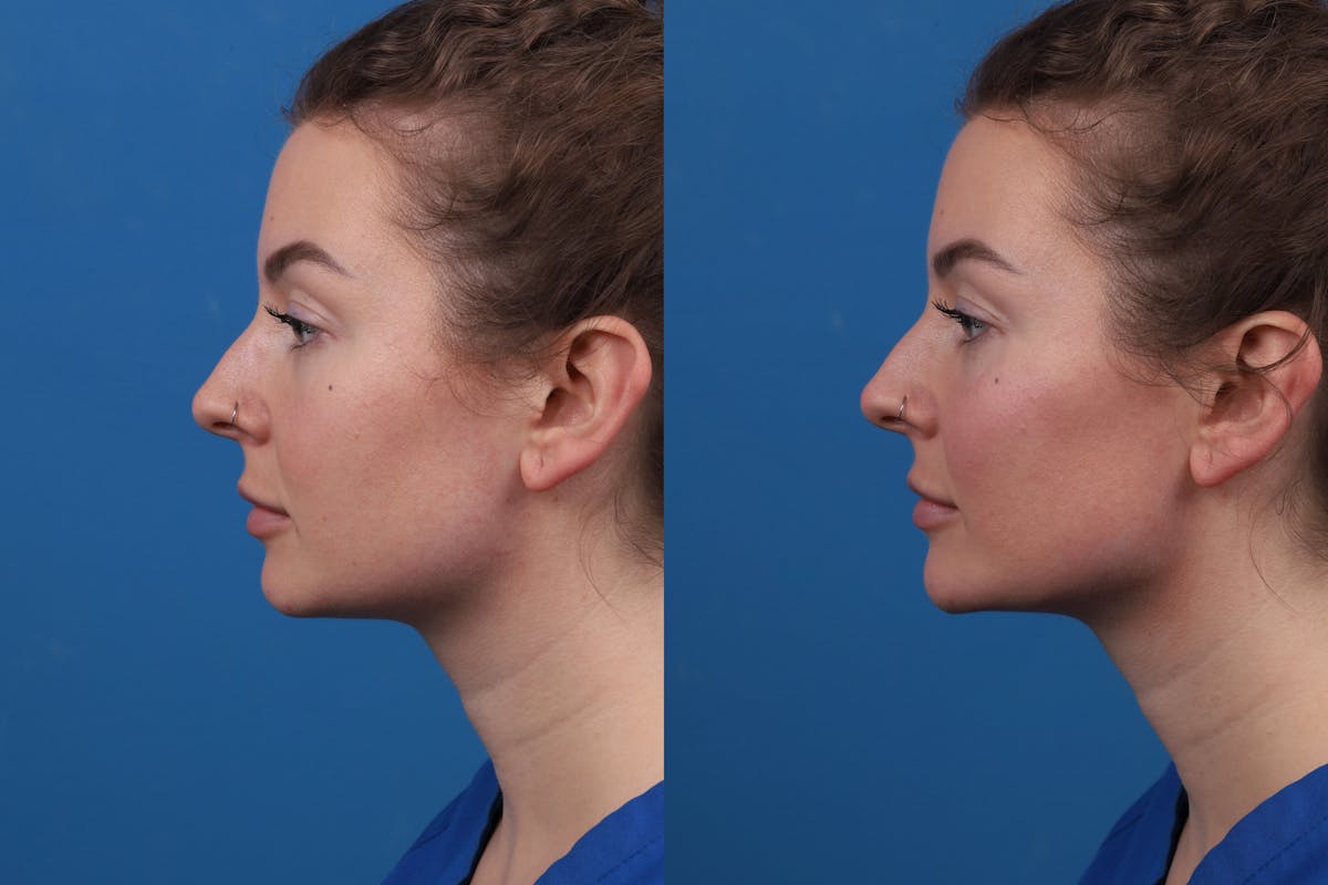 Dermal Fillers Before & After Gallery - Patient 327316 - Image 5