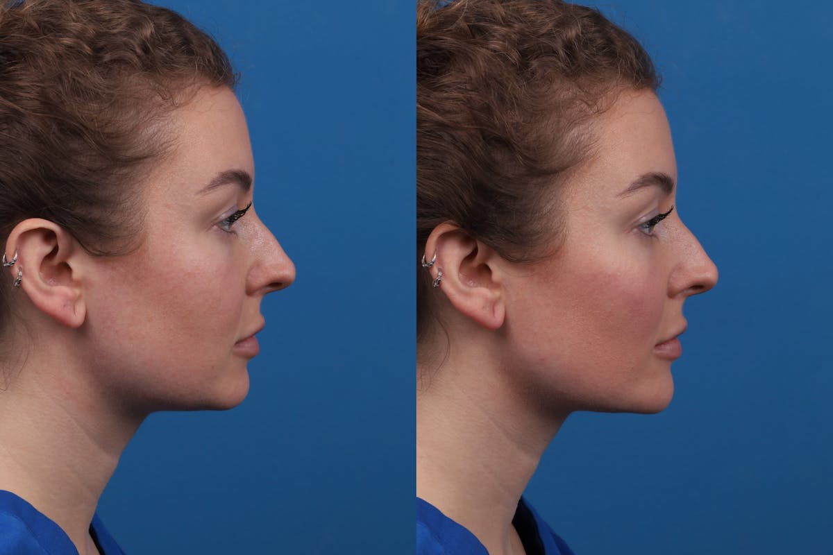 Dermal Fillers Before & After Gallery - Patient 327316 - Image 4