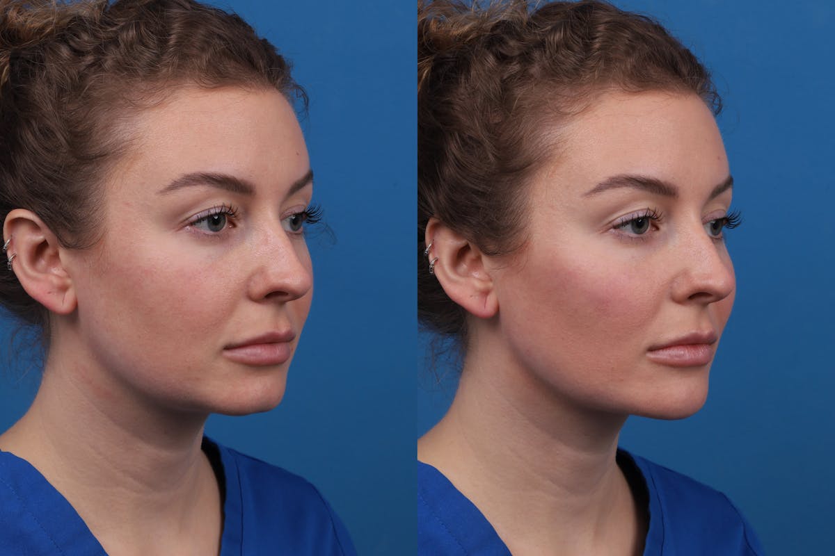 Dermal Fillers Before & After Gallery - Patient 327316 - Image 2