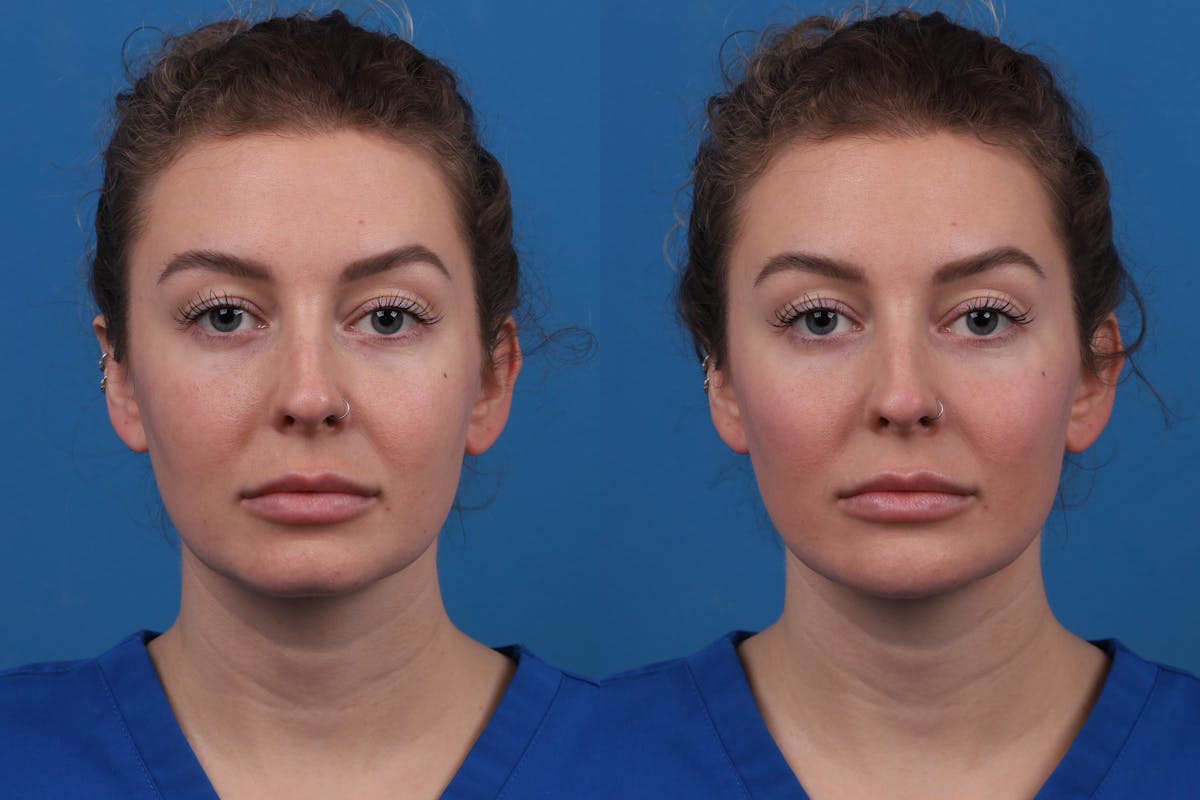 Dermal Fillers Before & After Gallery - Patient 327316 - Image 1