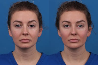 Dermal Fillers Before & After Gallery - Patient 327316 - Image 1