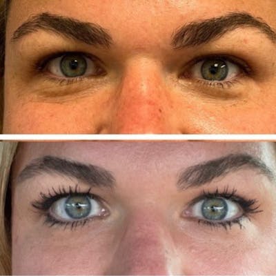 Dermal Fillers Before & After Gallery - Patient 327049 - Image 1