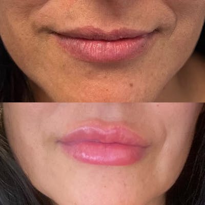 Lip Fillers Before & After Gallery - Patient 410732 - Image 1
