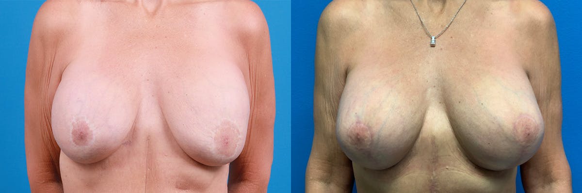 Breast Implant Exchange Before & After Gallery - Patient 499176 - Image 1