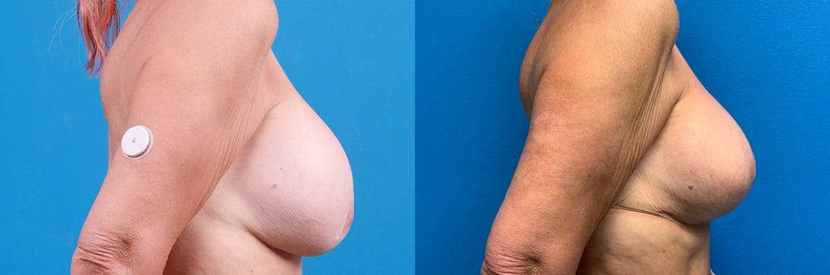 Breast Implant Exchange Before & After Gallery - Patient 499176 - Image 2