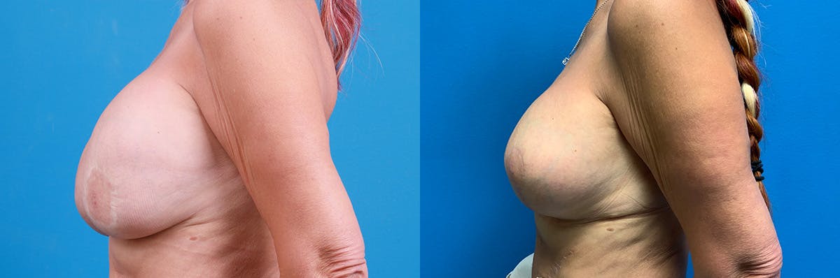 Breast Implant Exchange Before & After Gallery - Patient 499176 - Image 3