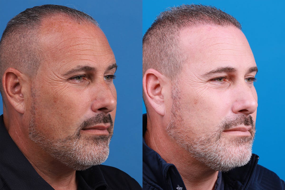 Hair Restoration Before & After Gallery - Patient 257756 - Image 4