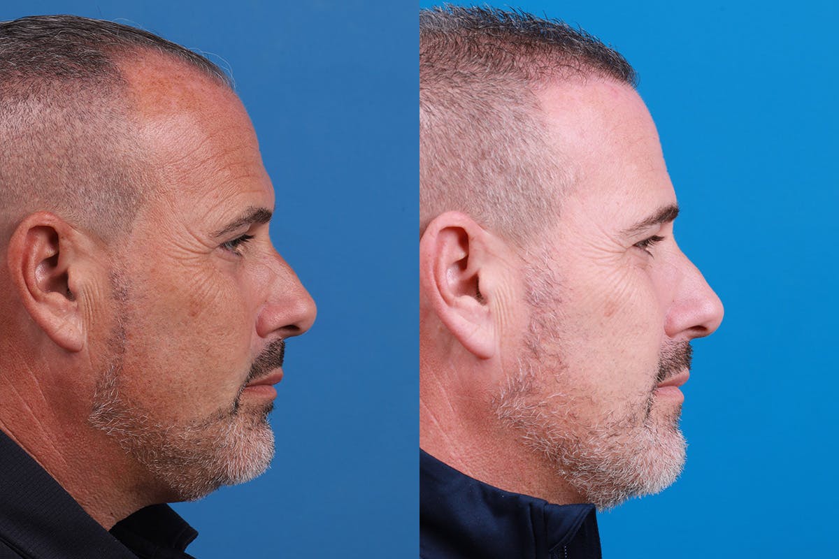 Hair Restoration Before & After Gallery - Patient 257756 - Image 5