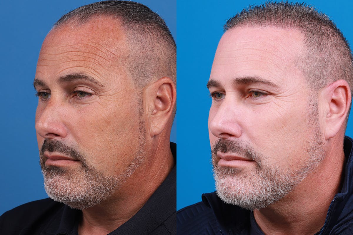 Hair Restoration Before & After Gallery - Patient 257756 - Image 6