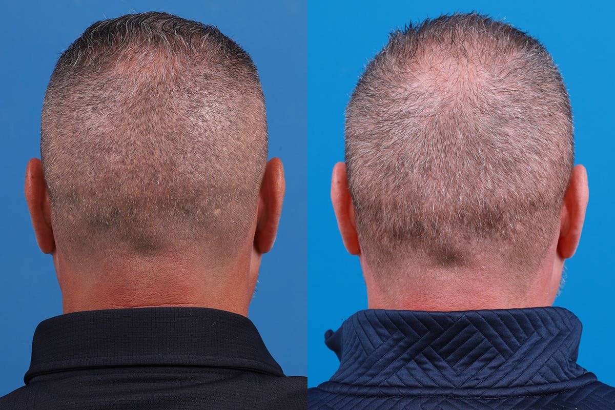 Hair Restoration Before & After Gallery - Patient 257756 - Image 8