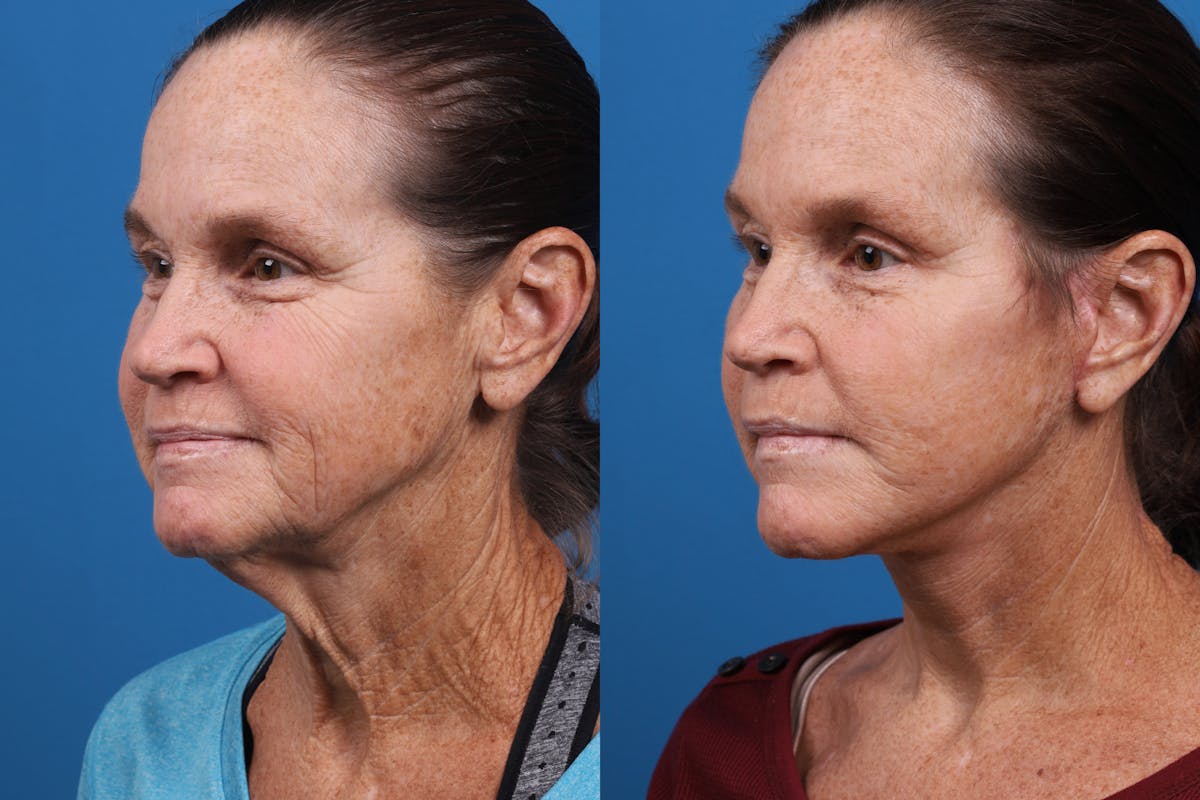 Facelift Before & After Gallery - Patient 159252 - Image 4