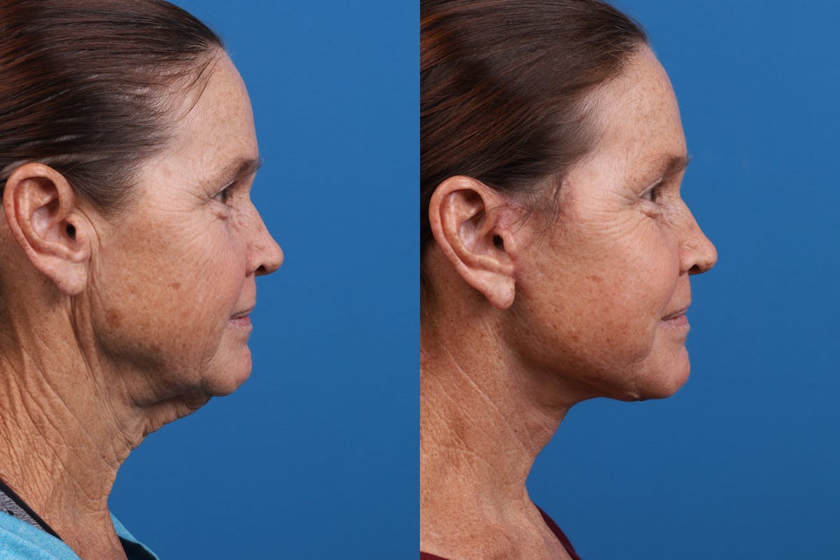 Facelift Before & After Gallery - Patient 159252 - Image 3