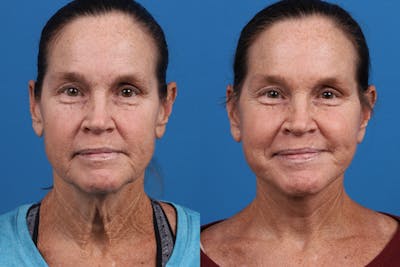 Facelift Before & After Gallery - Patient 159252 - Image 1