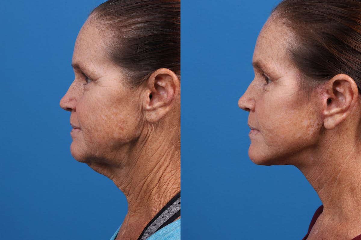 Facelift Before & After Gallery - Patient 159252 - Image 5