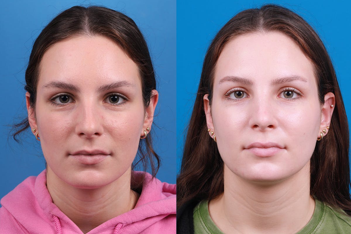 Rhinoplasty Before & After Gallery - Patient 405628 - Image 1