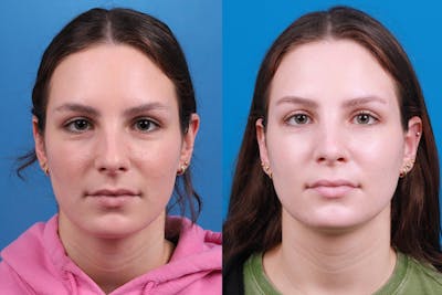 Rhinoplasty Before & After Gallery - Patient 405628 - Image 1