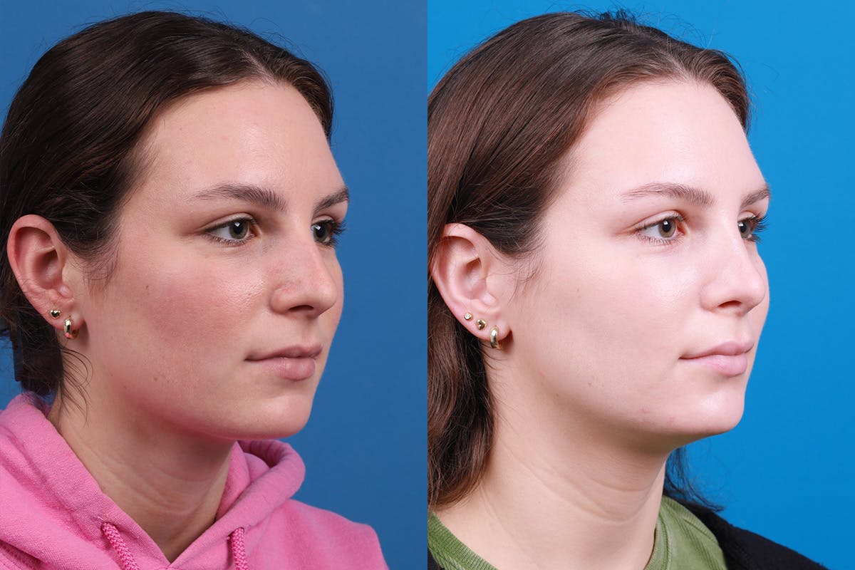 Rhinoplasty Before & After Gallery - Patient 405628 - Image 2