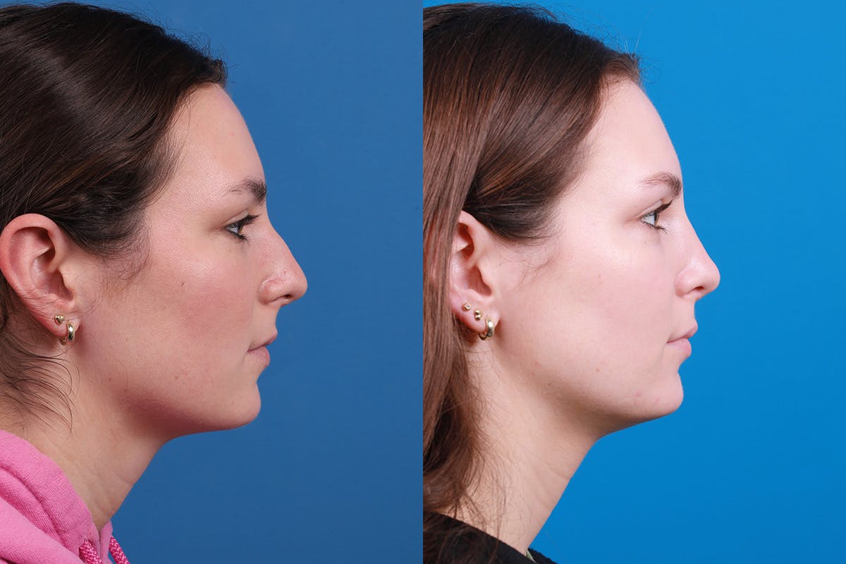 Rhinoplasty Before & After Gallery - Patient 405628 - Image 3