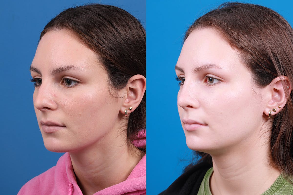 Rhinoplasty Before & After Gallery - Patient 405628 - Image 4