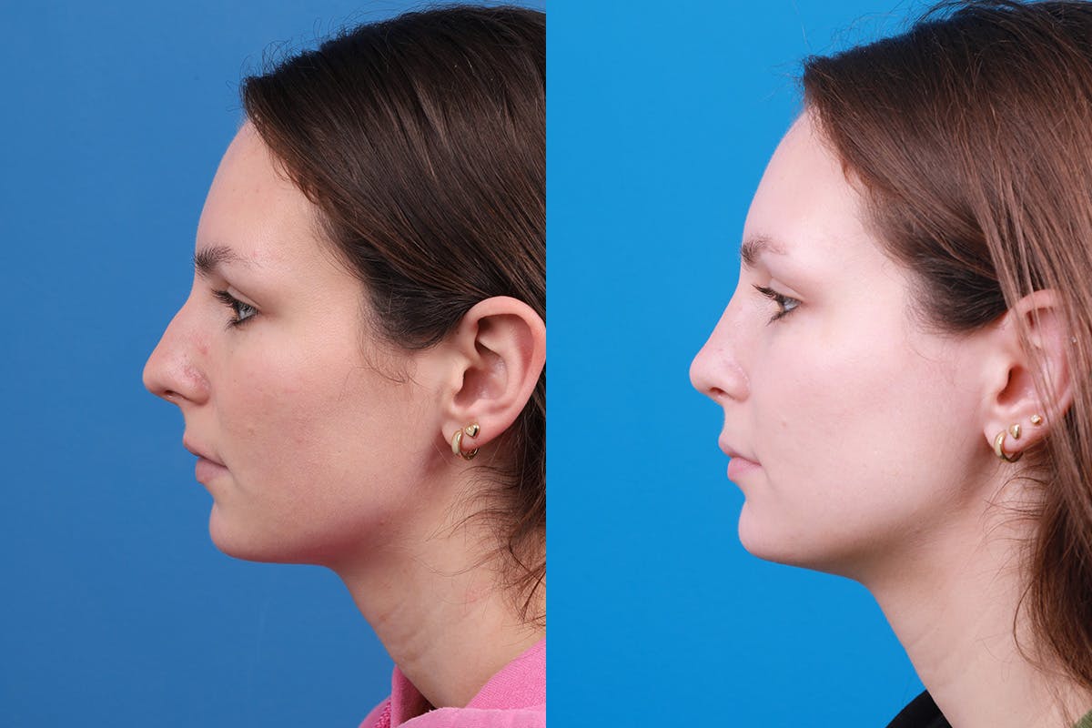 Rhinoplasty Before & After Gallery - Patient 405628 - Image 5