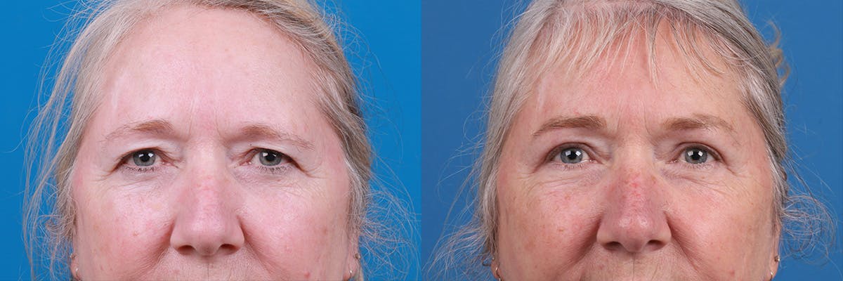 Brow Lift Before & After Gallery - Patient 103374 - Image 1