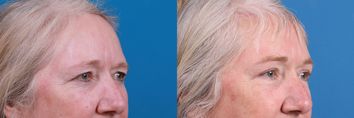 Brow Lift Before & After Gallery - Patient 103374 - Image 2