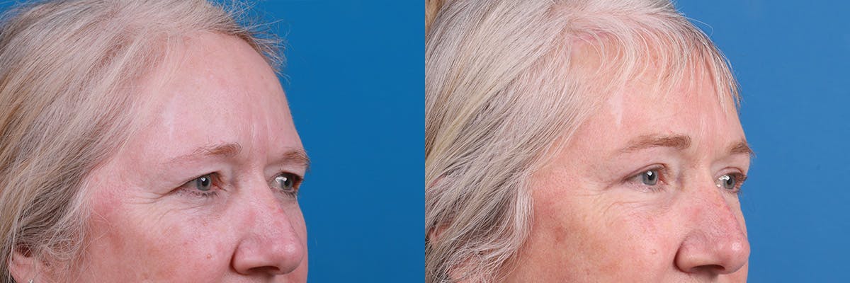 Eyelid Surgery Before & After Gallery - Patient 195870 - Image 2